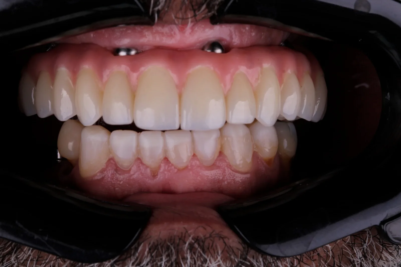 Prótesis dental